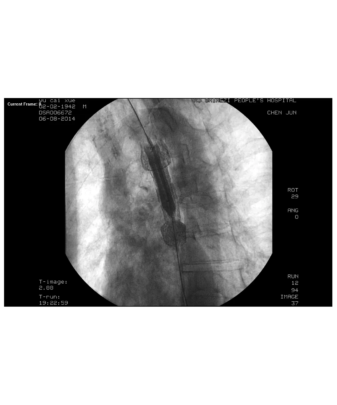 Non Vascular Sterile Hydro Slide Guidewires