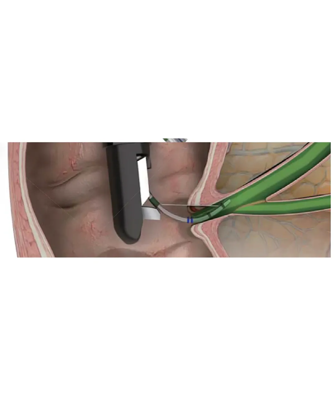 SHOW Sphincterotomes