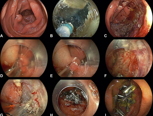 Underwater Reopenable Clip Closure Of Mucosal Defects After Duodenal Endoscopic Submucosal Dissection