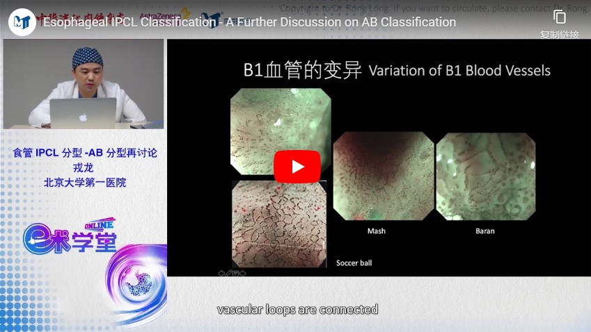 Esophageal IPCL Classification - A Further Discussion On AB Classification