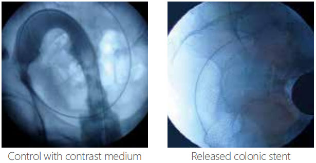 Colonic and Rectal Stents